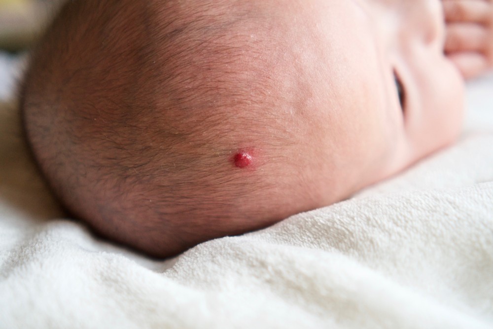 有些血管瘤生長的位置,可能會影響寶寶的視力、呼吸或聽力等等,雖然這種情況很少見。