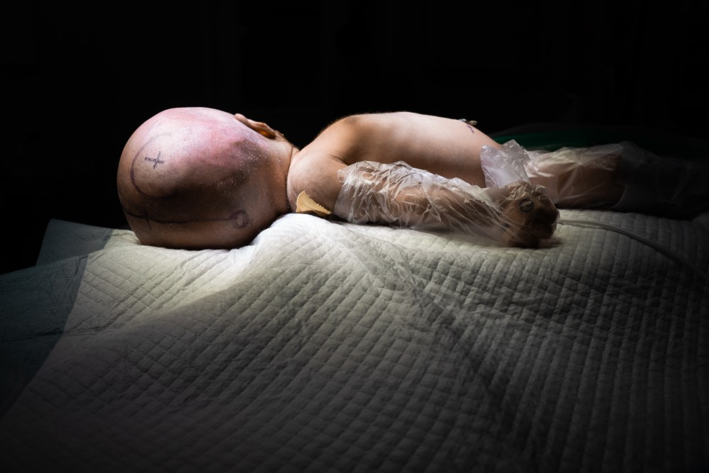 腦部尺寸異常大是腦脊液症狀之一。