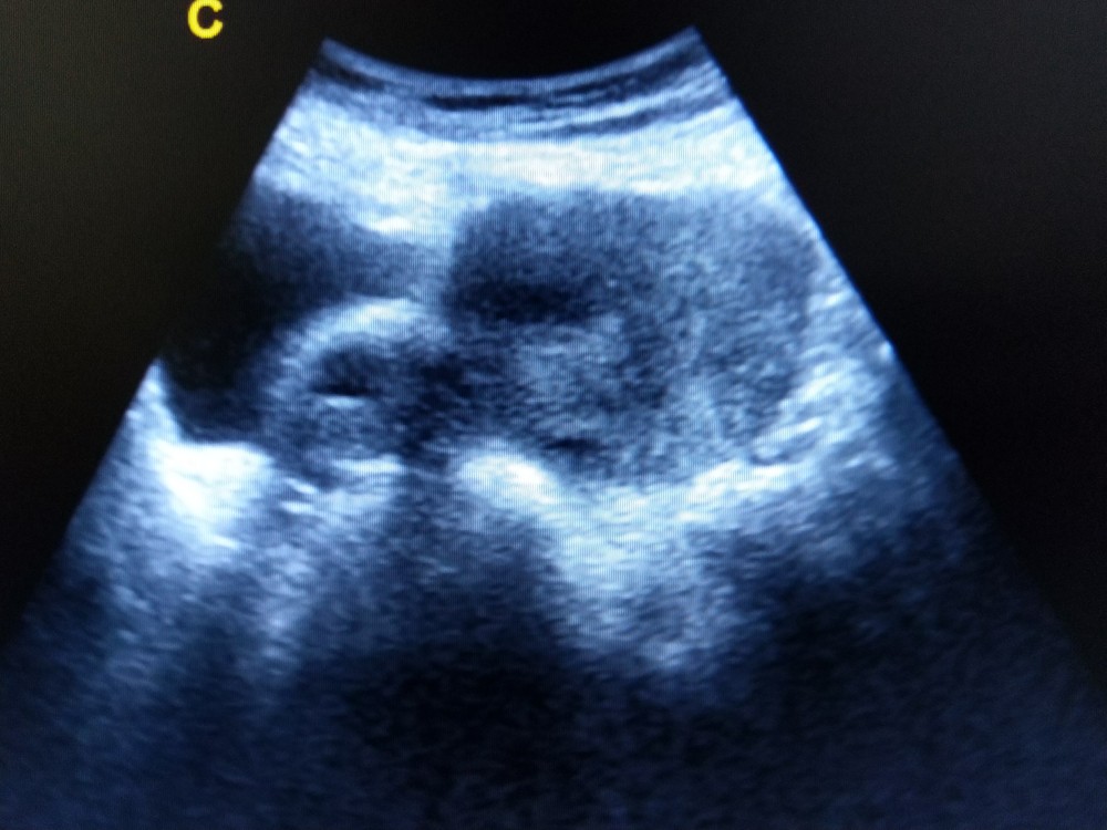 畸胎瘤在前期多數沒有症狀,通常都是在進行體檢或超聲波時被發現。