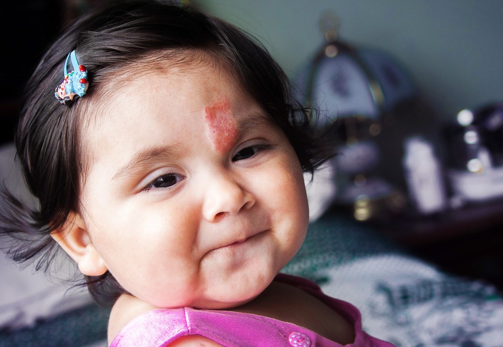 血管瘤女嬰比男嬰的發病率高2-5倍,白種人的比例居多。