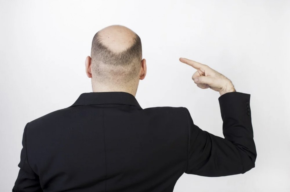 美國有研究發現,禿頭男性染上嚴重新型肺炎風險較高,相信導致禿頭的「雄激素」或與男性患重症新型肺炎有關。