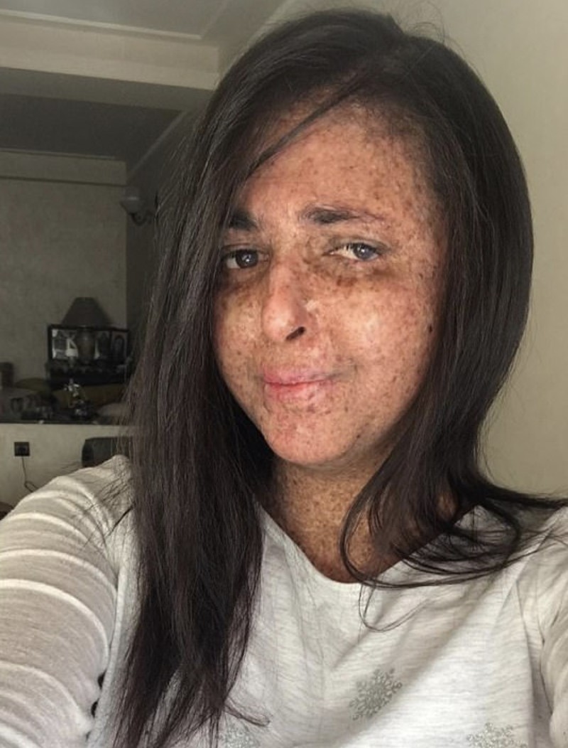 今年28歲的Fatima,2歲時被父母發現皮膚上出現嚴重雀斑,求診後確診患上罕見的著色性乾皮病。