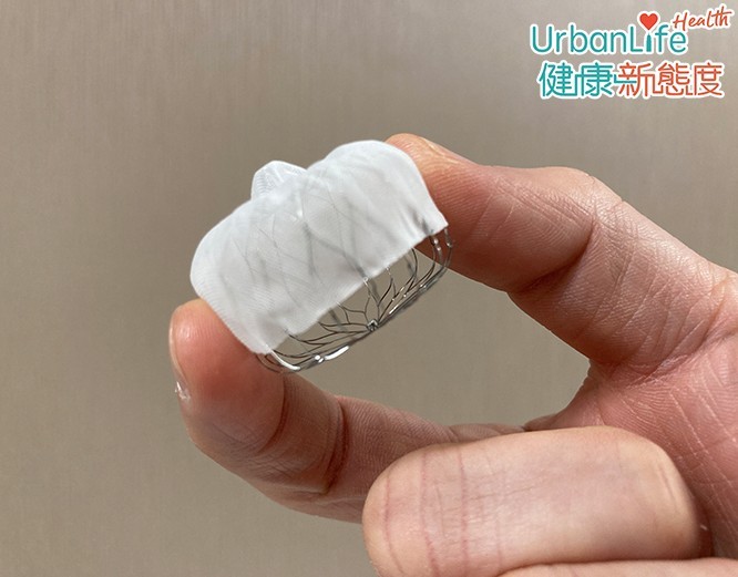 封堵器是一個合金支架,上面的篩網容許血液流動,但血塊無法通過。