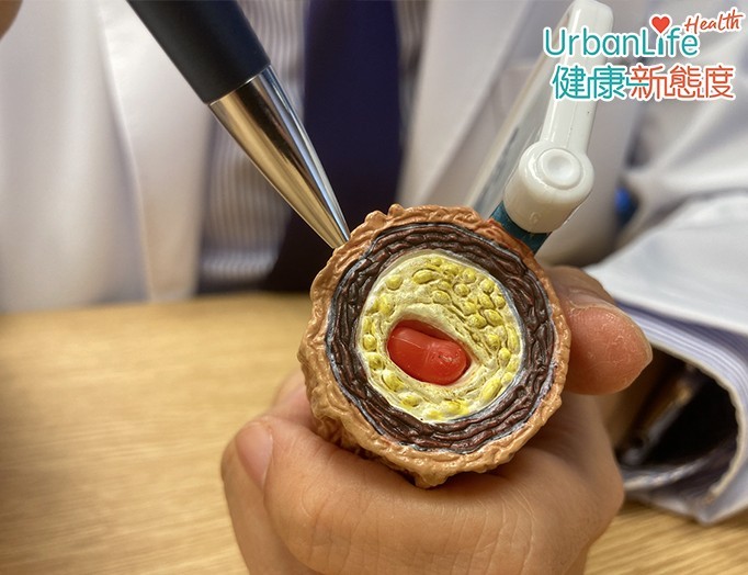 由於在短時間內因情緒問題而釋出大量賀爾蒙,令血小板容易積聚,因此急性血管阻塞。