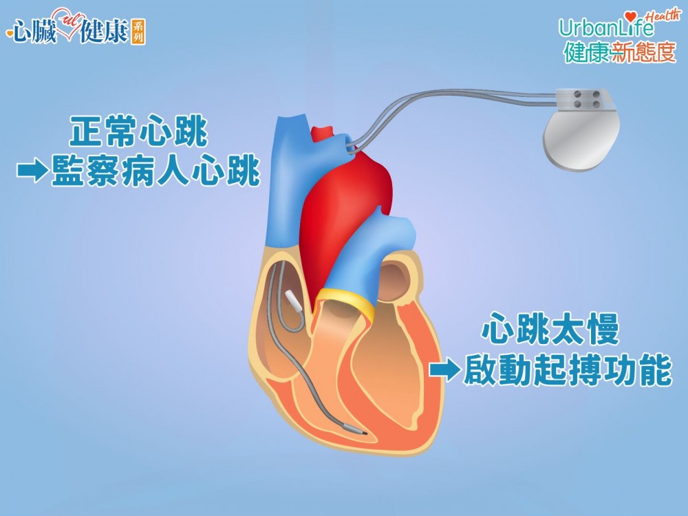 起博器會監察心跳是否正常,當它發覺心跳開始太慢就會開啟起博功能。