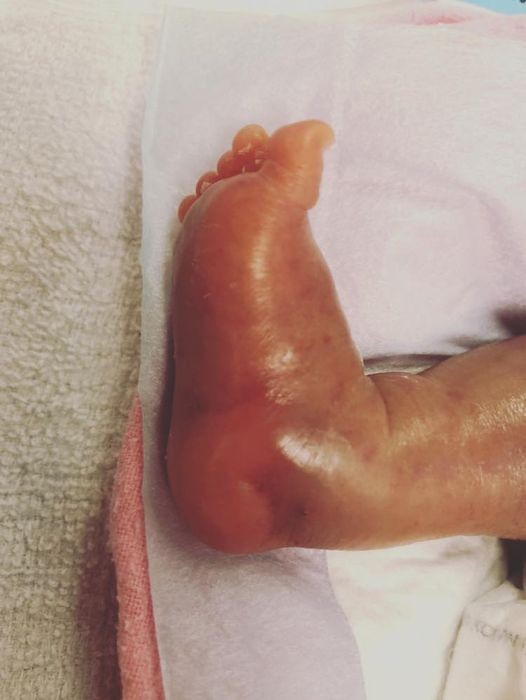 昨日秋彥病情好轉，成功排出9ml尿液，腳的水腫情況亦有改善。