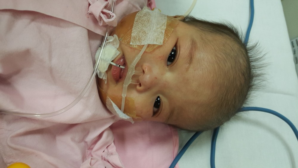 現時3歲多的恩德患有先天性肺動脈閉鎖。