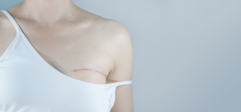 乳房保留術,醫生會把患者乳房中的腫瘤以及周邊組織切除,再配合放射治療,降低局部復發的機會。