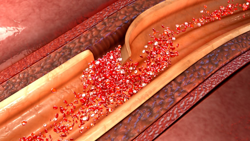 當主動脈破裂,血液會流到中層及外層之間,將主動脈撕裂剝離成兩個腔室,造成主動脈剝離。