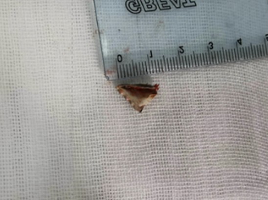 經過氣管鏡下凍融,用鉗竟取出了一塊約1厘米的塑料包裝角。