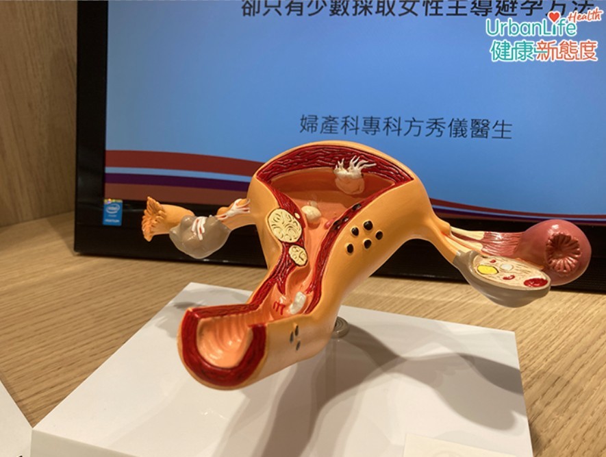 事後避孕藥主要成分為黃體素,黃體素可抑制排卵,防止受精卵著床。