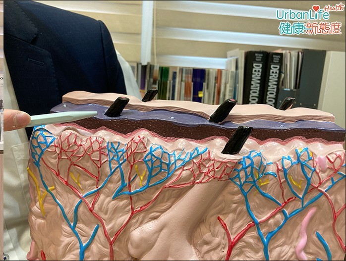 濕疹患者的表皮細胞未能鎖緊水分。