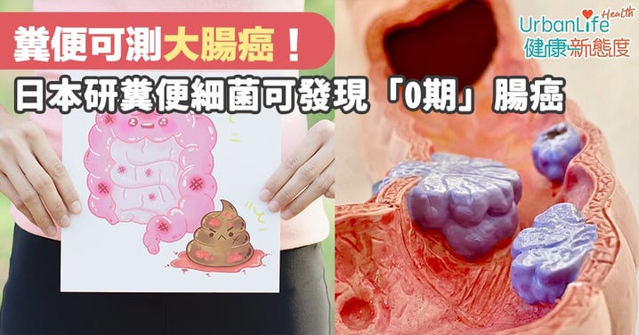 【大腸癌檢查及症狀】糞便可測大腸癌!日本研糞便細菌可發現「0期」腸癌