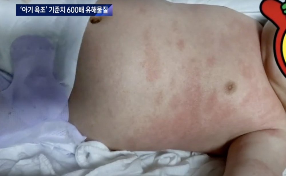 據韓媒報導指，有韓國父母聲稱，孩子疑因使用Daiso嬰兒浴缸後，皮膚發炎。