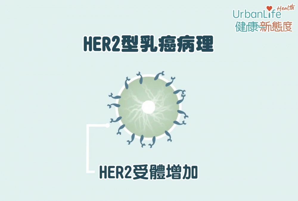 HER2型乳癌病理。