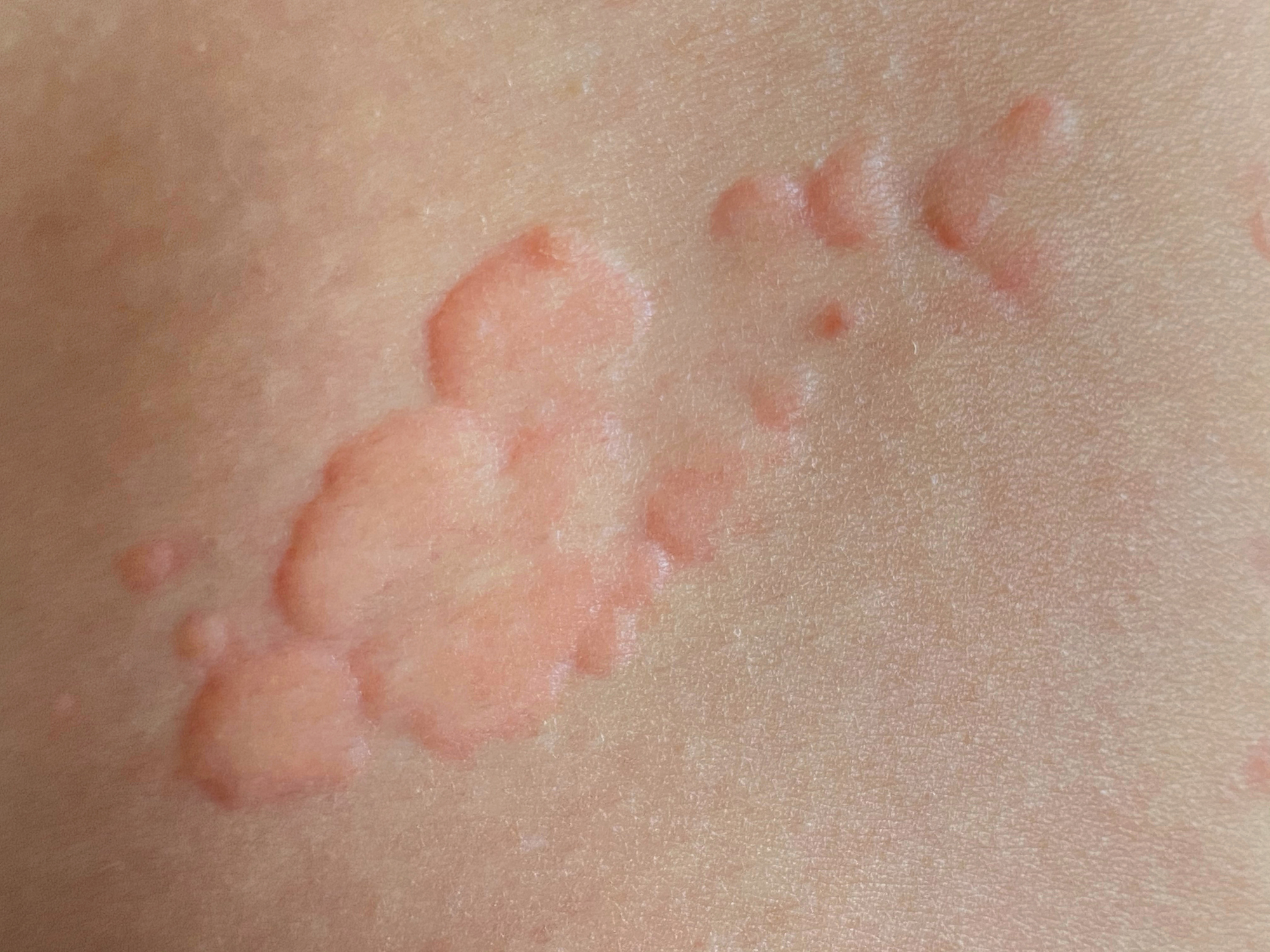 蕁麻疹令患者又痕又難受,究竟有甚麼方法可以舒緩?