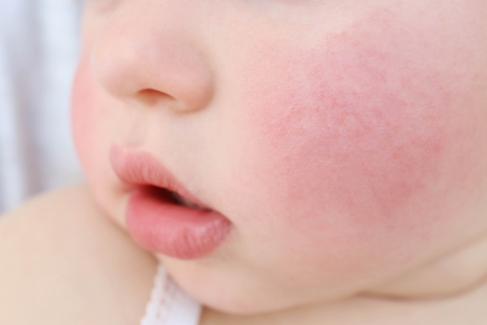 嬰幼兒敏感會現濕疹、紅腫、痕癢