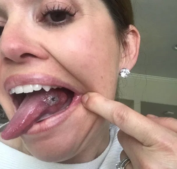 37歲的Jamie Powel咬傷舌頭後兩週後傷口卻發黑。