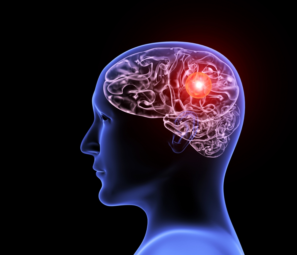 由腦膜炎雙球菌(Neisseria meningitidis)引起的腦膜炎稱為流行性腦脊髓膜炎。