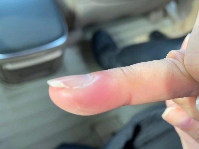 藝人鄧萃雯日前手指生倒刺,因為不恰當處理而令情況惡化。