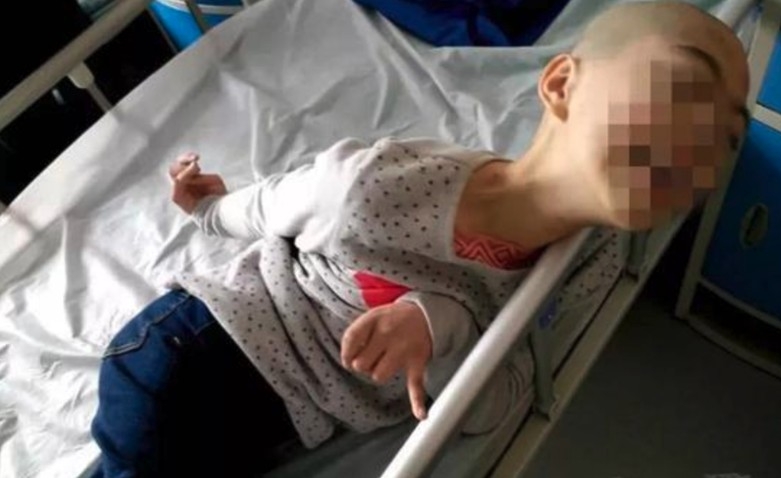 11歲來自河南南陽的女生文文(化名),因為口渴就飲用了家中媽媽用約五十克山豆根泡的水後,出現頭暈、嘔吐,甚至手腳變形等症狀。