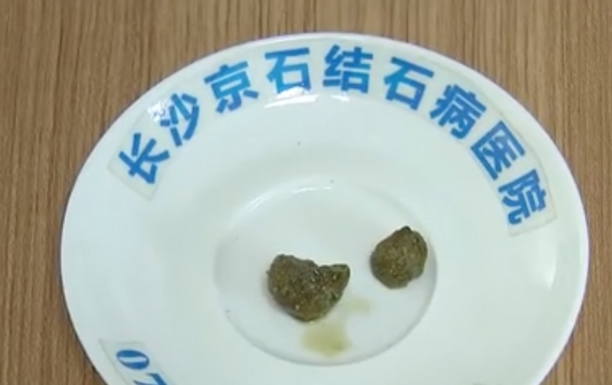 女子求醫院檢查發現膽囊有2cm結石作怪,取出後痛症才消除。