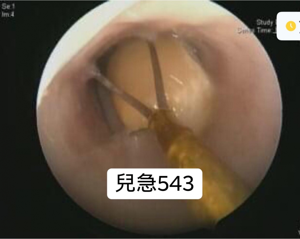 醫生檢查後發現女童的支氣管被花生糖塞滿,如再延遲就醫可能有生命危險。