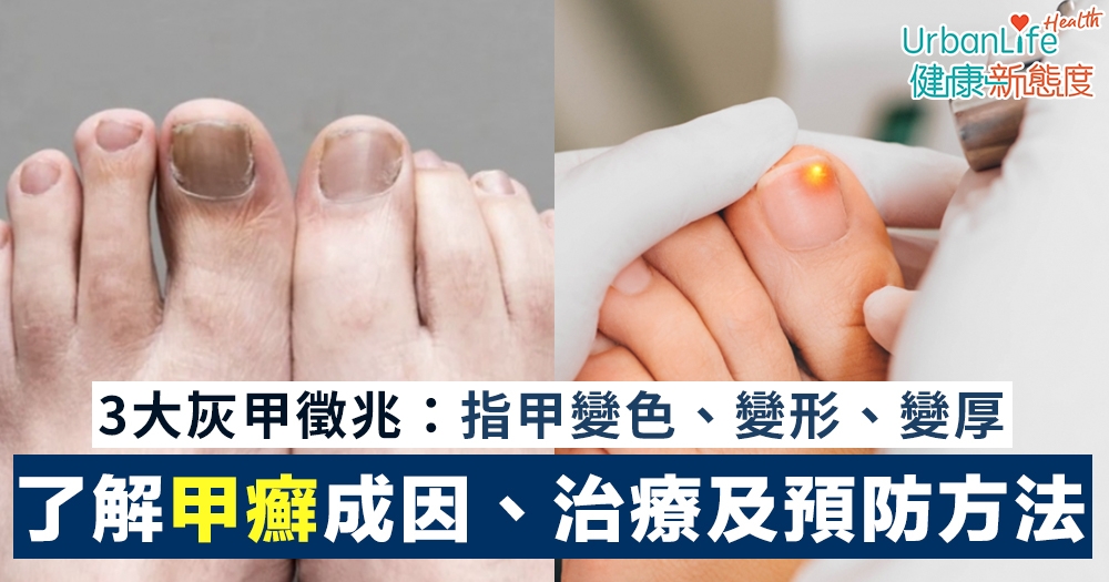 【灰甲治療】了解甲癬成因及預防 3大徵兆:指甲變色/變形/變厚