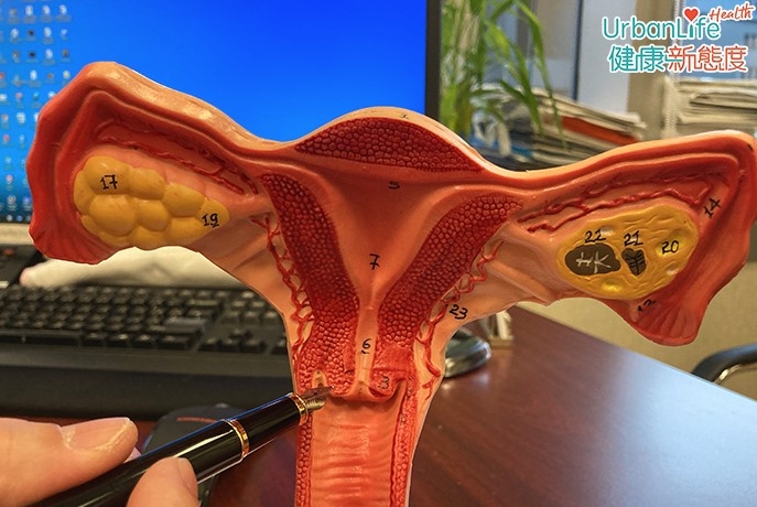 如被人類乳頭狀病毒感染後,子宮黏膜會產生病變。