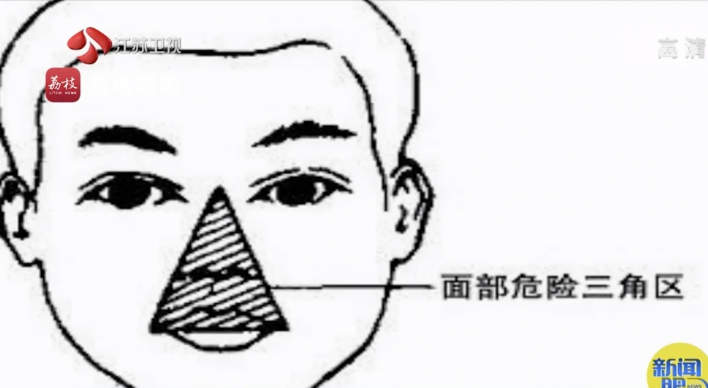 李男的痘痘位置長在「危險三角區」,亦即從鼻根到兩個口角形成的三角區域。