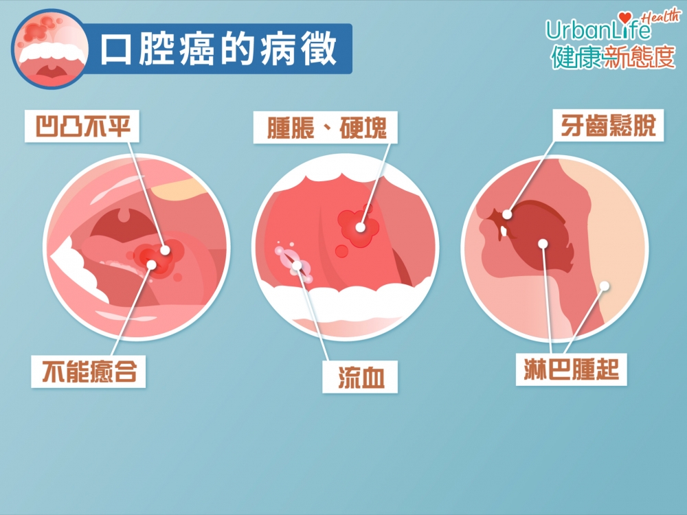 口腔癌有5大病徵。