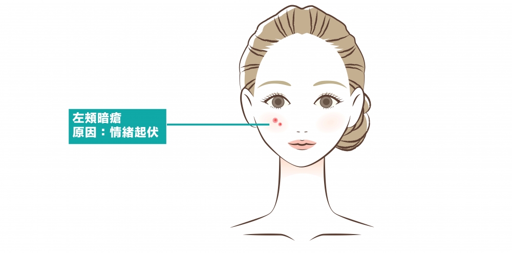 左頰代表著肝臟,若此處長暗瘡一般是因為情緒抑鬱、夜睡時而導致肝臟蘊熱。