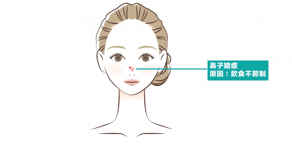 鼻子代表著脾臟,若這裡長暗瘡則表示消化系統對你「發出警號」了。