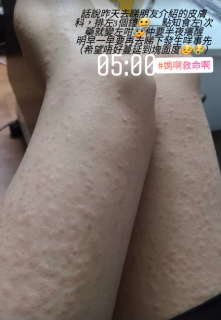 《東張西望》女主持利穎怡,多年來都受濕疹折磨,近日她在社交平台上載兩張照片,相中可見她的雙腿都長滿凹凸不平的風癩