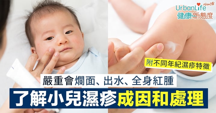 【BB濕疹原因】嚴重會爛面、出水、全身紅腫 了解小兒濕疹成因和處理