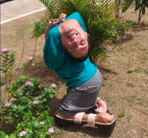 巴西男子奧利維拉(Claudio Vieira de Oliveira)患有罕見病,一出生頭顱便反折倒轉,而且四肢萎縮無法站立。