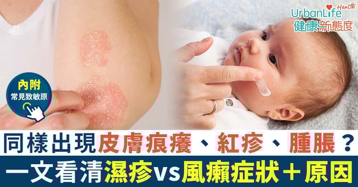 【濕疹VS蕁麻疹】同樣出現皮膚痕癢、紅疹?一圖區別兩者定義、症狀、原因與治療