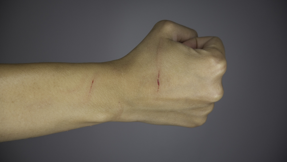 患者被貓劃傷或抓傷軟組織附近的淋巴結會出現腫、脹及疼痛。