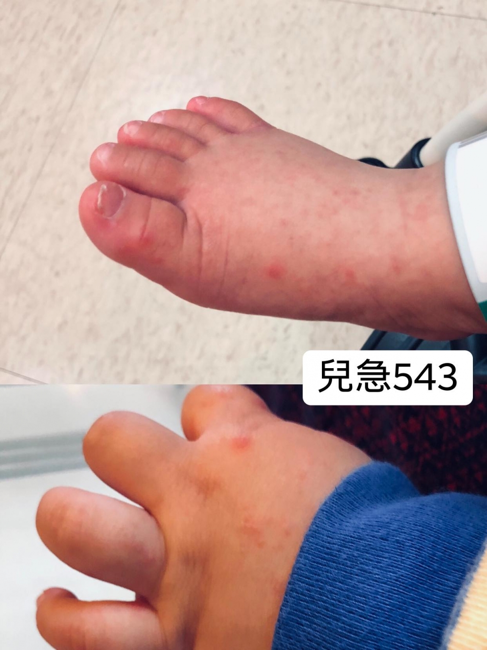 近日一名10個月大的男嬰參加爬行比賽後,手腳出紅疹、口腔嚴重潰爛。