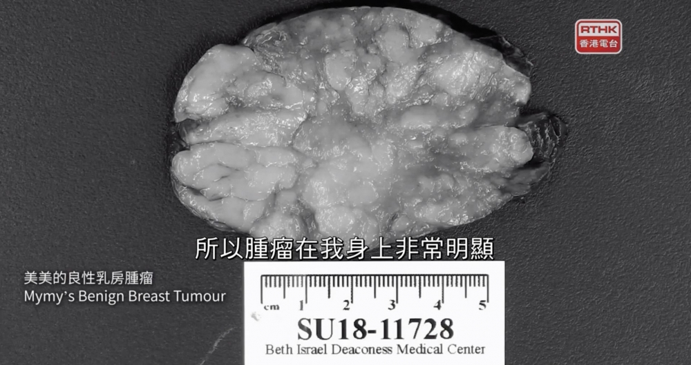 當她確診患上乳房良性腫瘤時，腫瘤闊度已超過5厘米，醫生只表示原因不明。