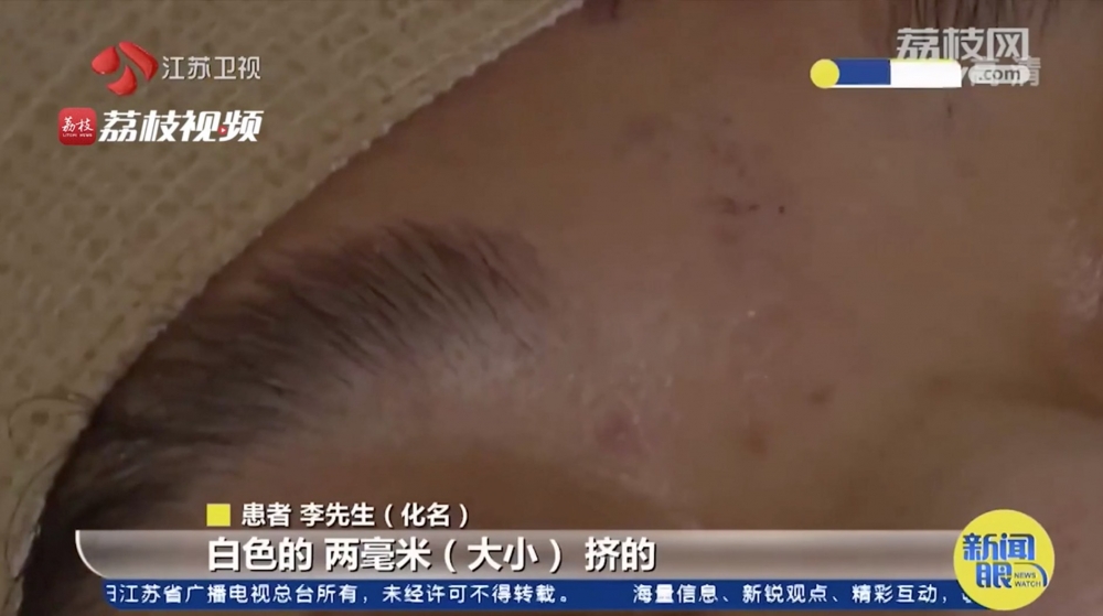 患者早前臉上長了一顆白色暗瘡,約2毫米大小,當下把它用手擠掉,但三、四天後他變得講話不清.
