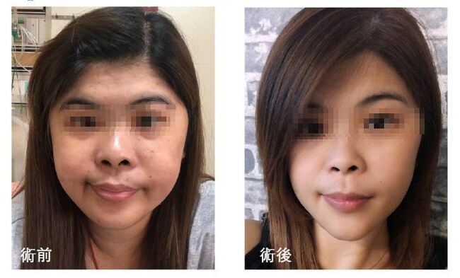 患者進行手術前後。