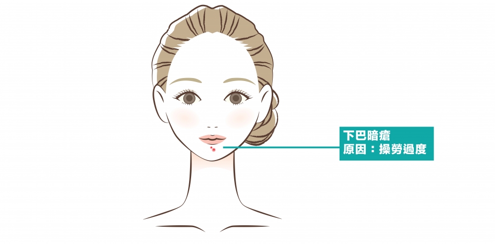 若下巴長出暗瘡表示腎虛火旺或內分泌失調。