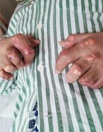 廣州27歲男子小俊(化名)雙手出現黃白色的痛風石。