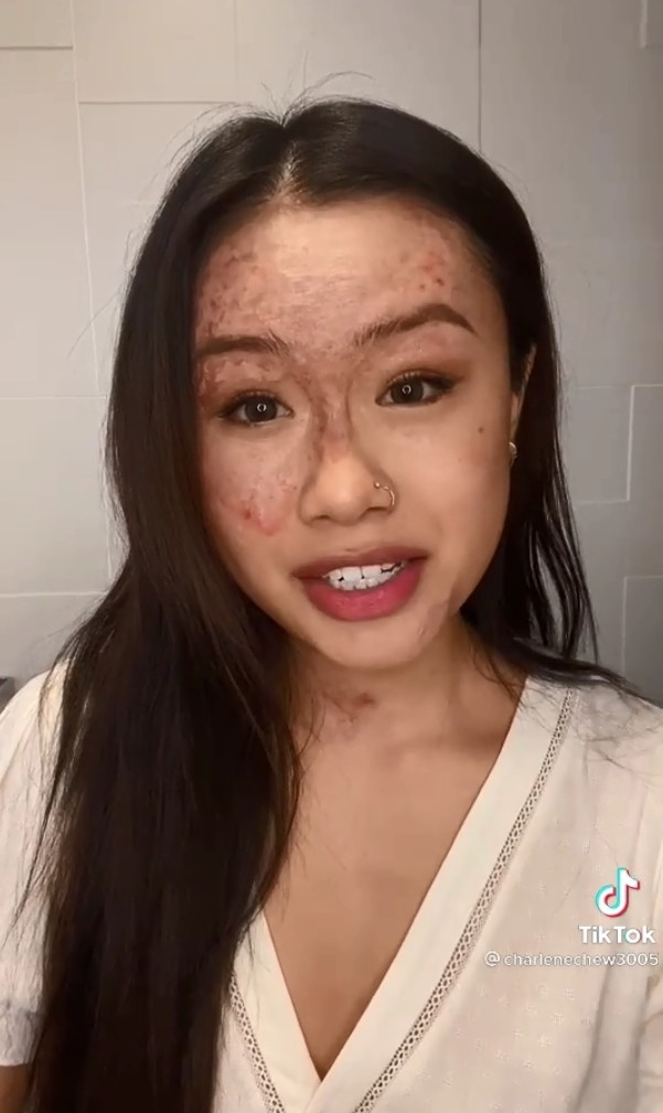 新加坡一名少女去年因意外導致臉部被滾油灼,傷造成3級燒傷毀容。