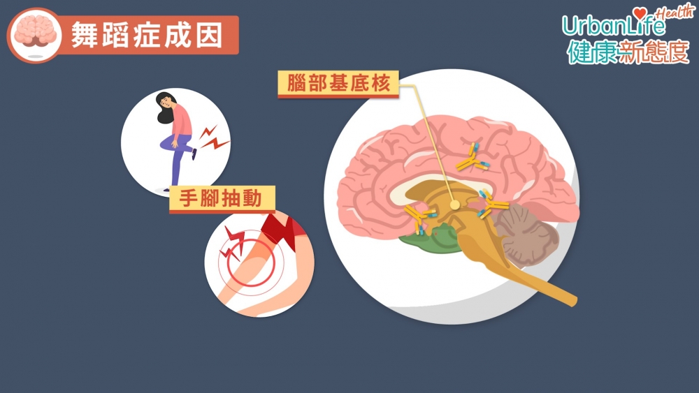 感染鏈球菌之後,身體會有抗體反應,抗體不止影響心瓣,還有機會影響到腦部協調肢體的中心。