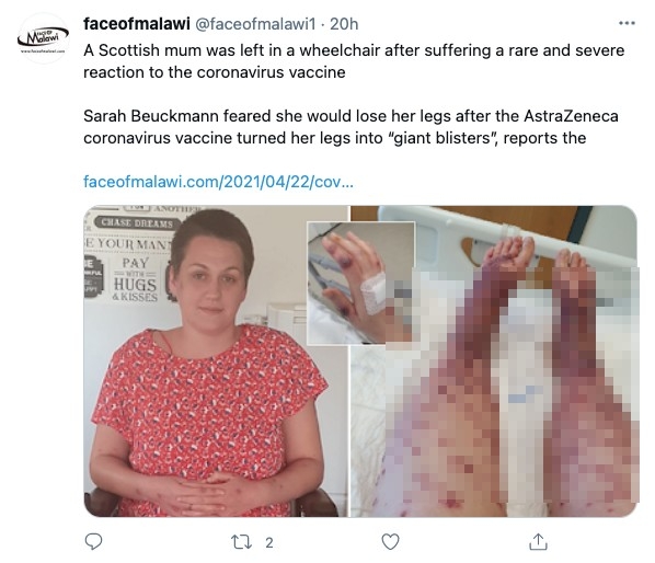 英國蘇格蘭一名女子於3月中接種首劑阿斯利康疫苗後出現罕見副作用。