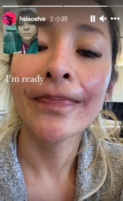 台灣天后蕭亞軒（Elva）與男友日前被家裡愛犬咬傷臉部，需到台北醫學大學附設醫院急症室治療。