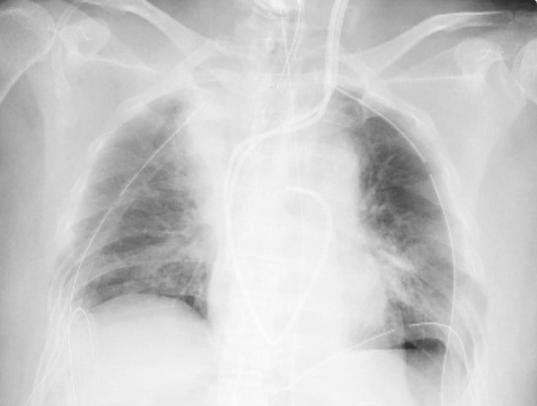 手術後，患者肺臟在X光片上已呈黑色，可正常發揮功能。