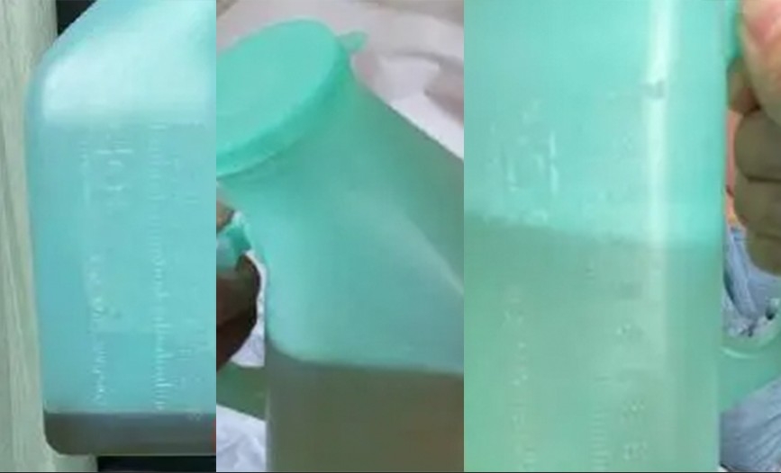徐男經搶救後度過危險期,尿液顏色漸漸變淡。